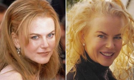 Nicole Kidman usa il botox
