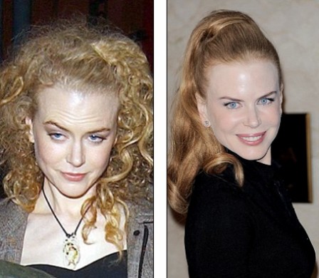 Nicole Kidman prima e dopo il botox