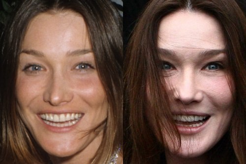 Carla Bruni rifatta prima e dopo