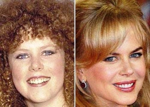 Nicole Kidman rifatta prima e dopo